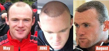wayne-rooney-before-after-hair-transplant
